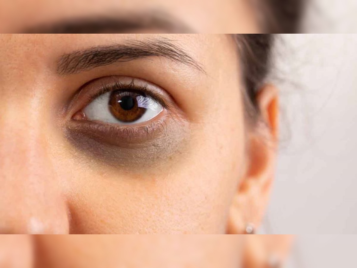 Eye Care Tips: डार्क सर्कल्स को कम करने के लिए अपनाएं टिप्स, कुछ ही दिनों में दिखेगा असर