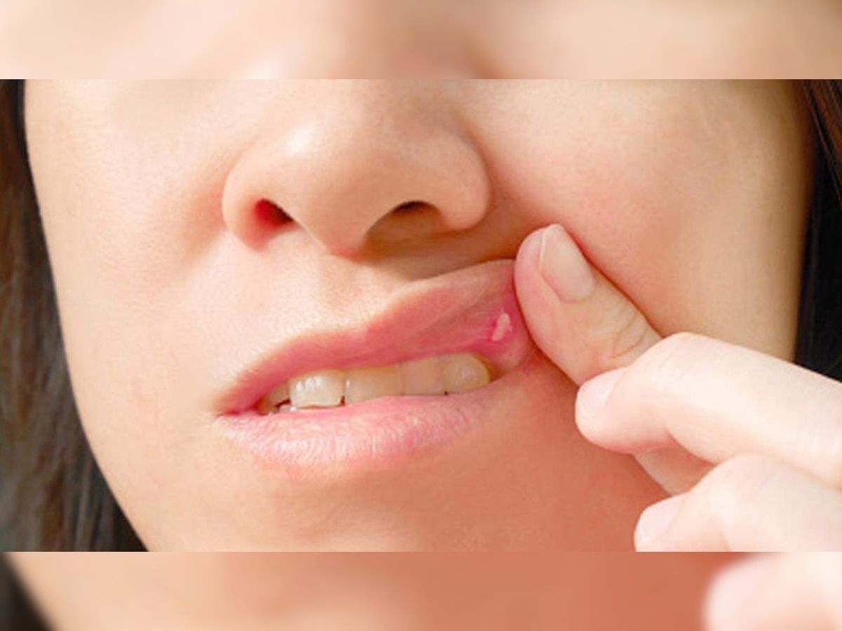 Mouth Ulcers: देसी नुस्खों से ठीक करें मुंह के छाले, दर्द, जलन में मिलेगा तुरंत आराम  