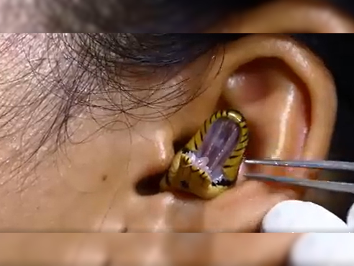 Snake Video: कान के अंदर घुस गया सांप, लड़की ने जैसे ही देखा तो भागते-भागते डॉक्टर के पास आई और फिर