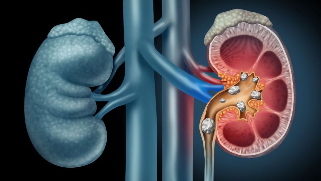 Health Tips: शरीर में आ रहे हैं ये बदलाव तो हो जाएं सावधान, Kidney Damage के हो सकते हैं संकेत