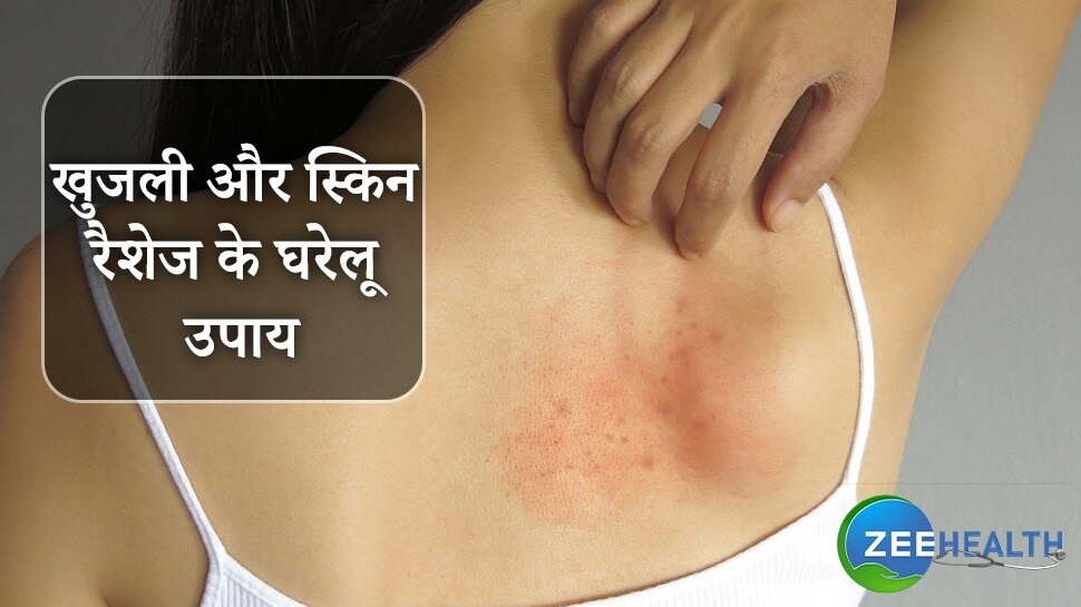 Try these home remedies to get relief from itching and skin rashes ...