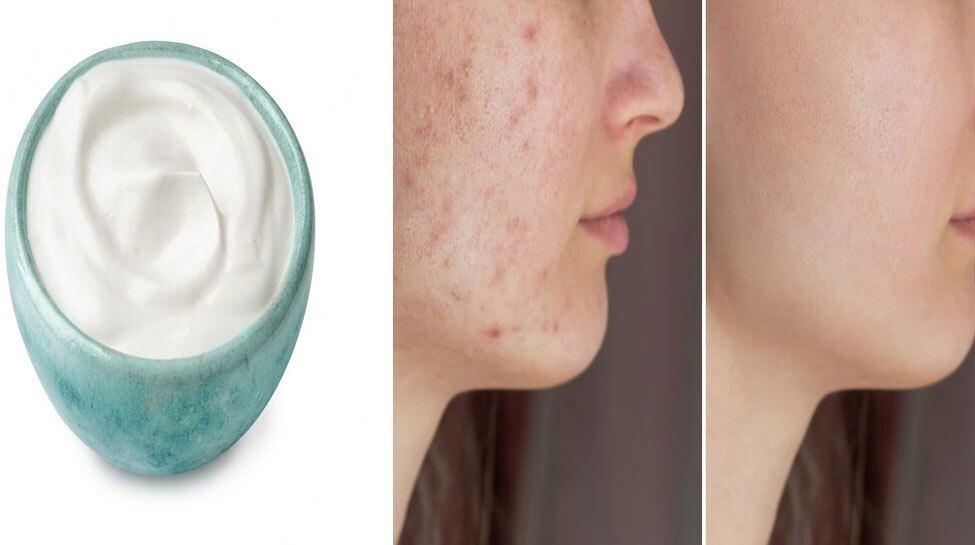 know here how to reduce scars home remedies How To Get Rid Of Scars