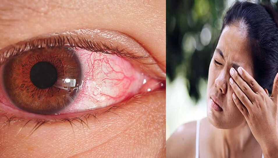 know here reasons of burning red eyes and how to relieve pain Burning