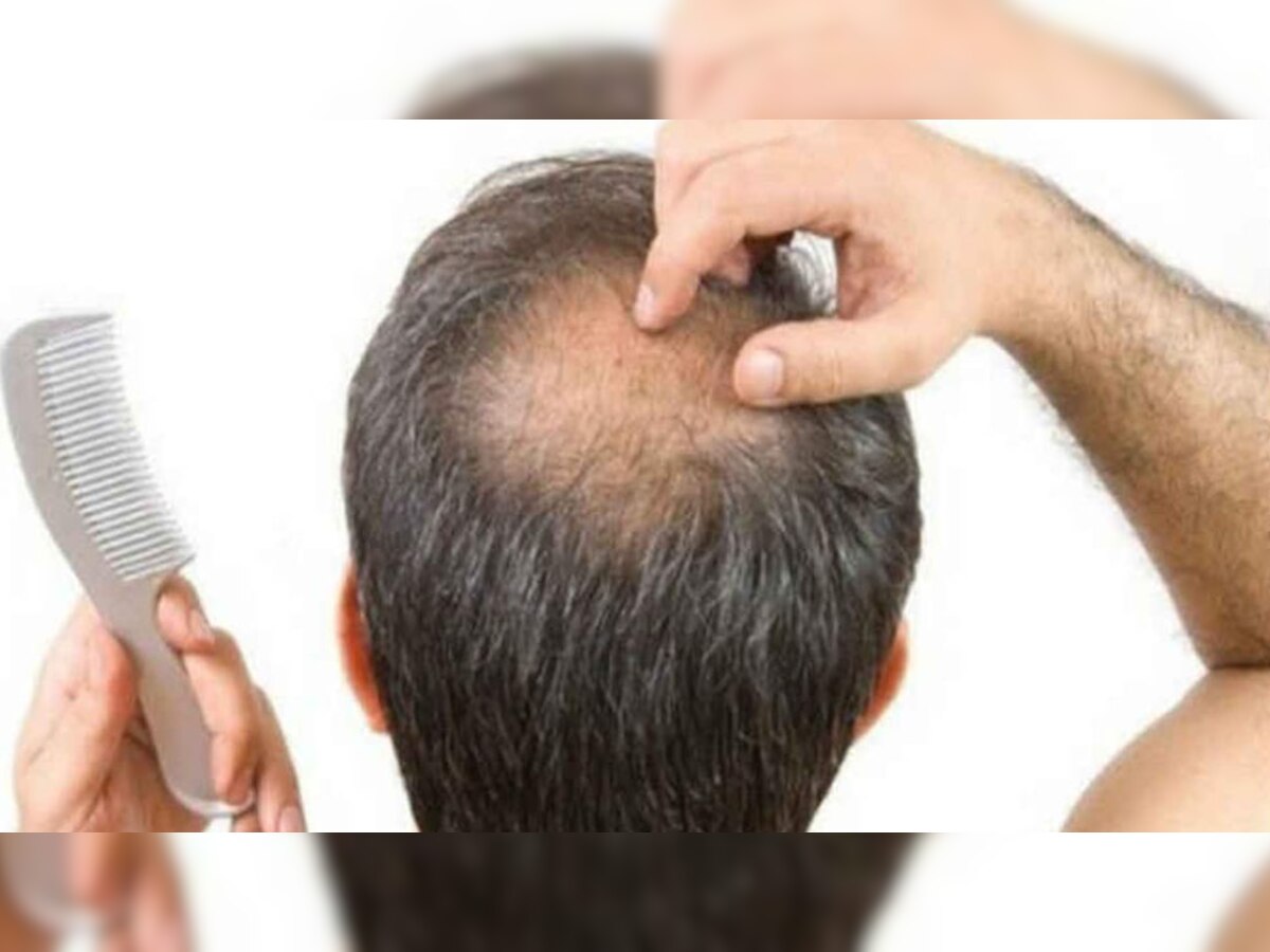 How to regrow hair: क्या आप भी धीरे-धीरे गंजेपन का हो रहे हैं शिकार? घबराएं नहीं, रोजाना कर लें 4 उपाय, फिर से उगने लगेंगे बाल