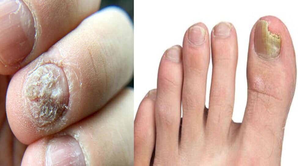 10 Ways to Get Rid Of Nail Fungus Forever at Home