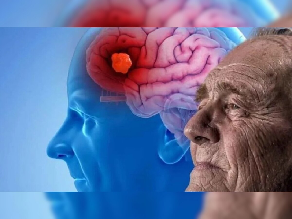 World Alzheimer's Day: ये खतरनाक बीमारी ब्रेन को करती है डैमेज, बढ़ती उम्र वालों को है रिस्क 