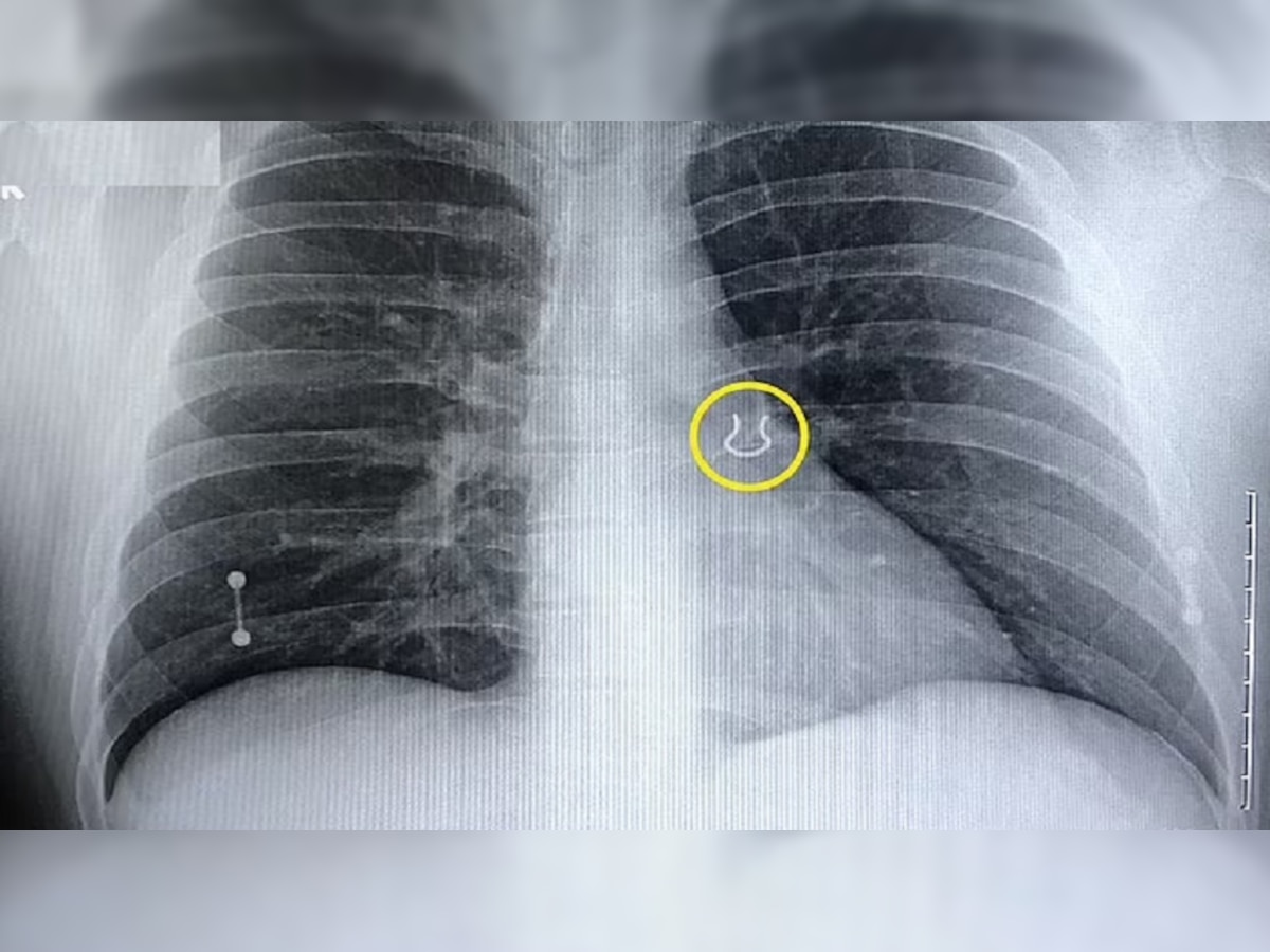 Ring in Lungs: शख्स के फेफड़े में हुआ दर्द, एक्सरे रिपोर्ट में दिखी पांच साल पहले खोई अंगूठी