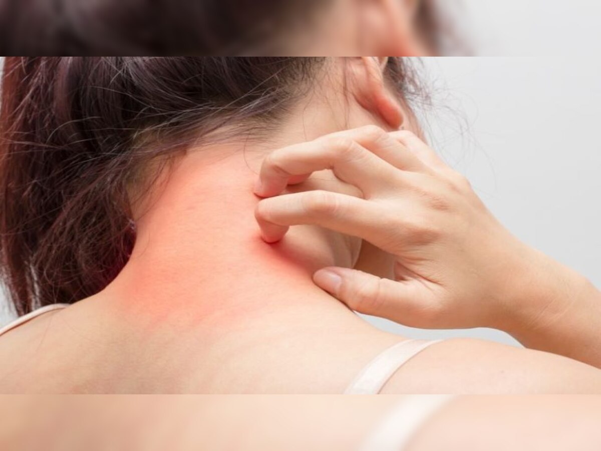 Itching: शरीर पर जगह-जगह होती है खुजली? तो अपनाएं ये घरेलू उपाय, नहीं होगी दिक्कत