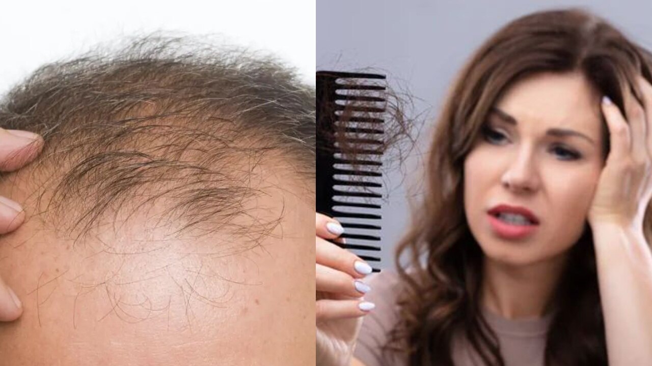 Hair Care: टूटते-झड़ते बालों की समस्या हो जाएगी छूमंतर! बस आज से शुरू करें ये आसान घरेलू उपाय