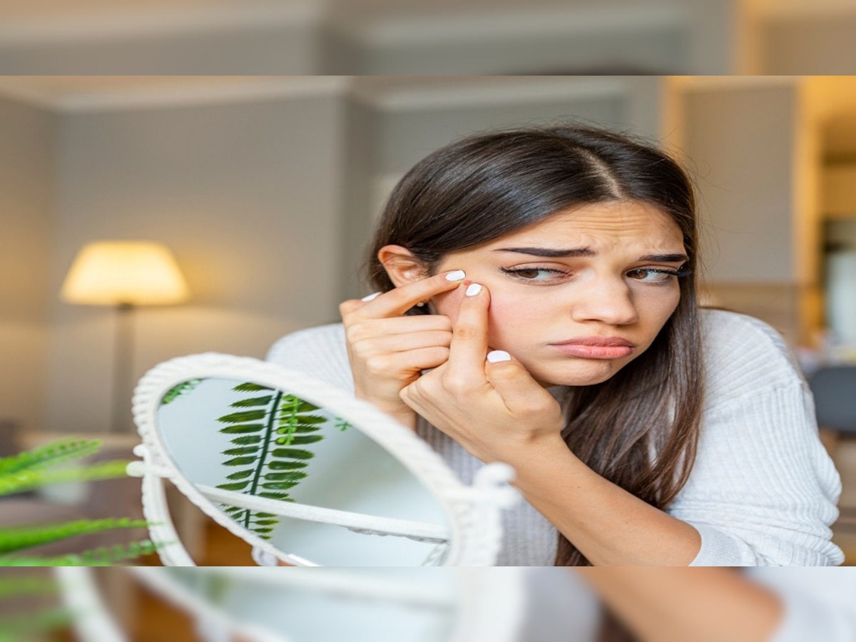 Pimple Removing Tips: इन चीजों के इस्तेमाल से गायब होंगे रातों-रात पिंपल्स, चेहरा बनेगा चमकदार 