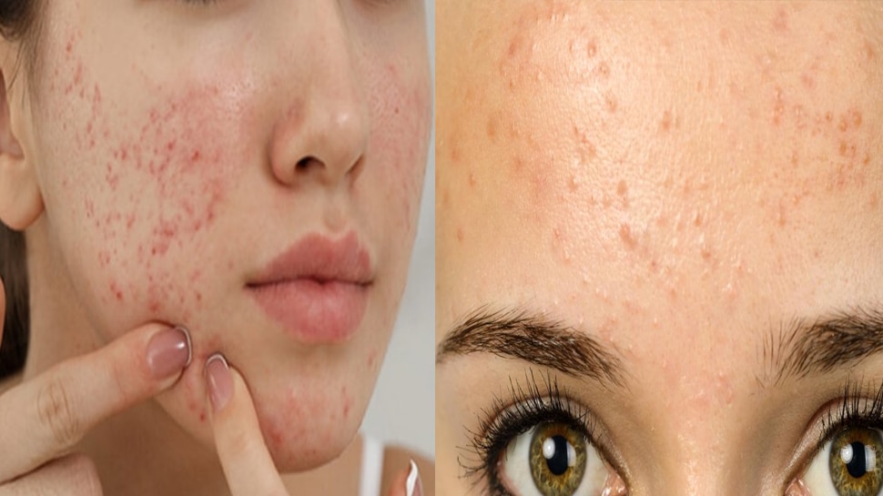 How to remove face pimples at home avoid these foods to remove acne and