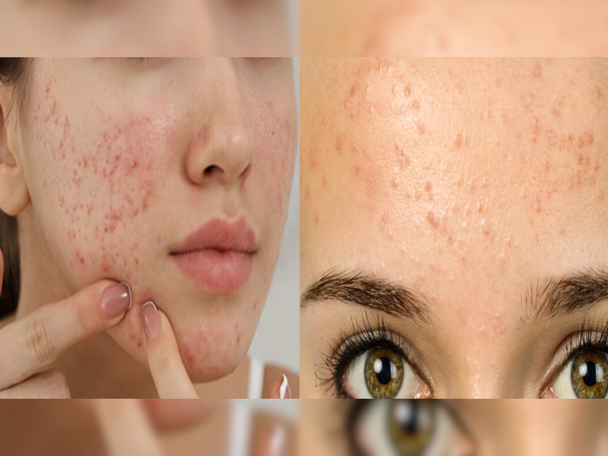 Face pimples: फेस पिंपल्स हो जाएंगे जड़ से खत्म, लेकिन इन 6 चीजों से करना होगा परहेज़