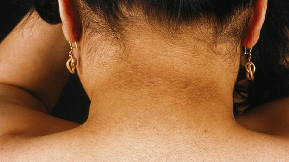 dark-neck-treatment-in-hindi-and-its-causes-remove-black-neck-from-home