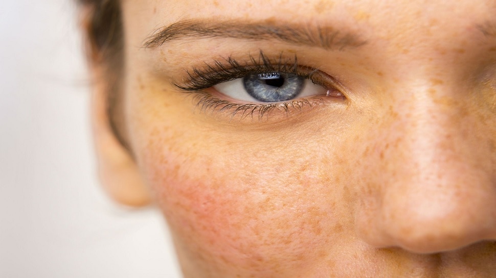 Home Remedies For Skin Pigmentation follow these steps will give you