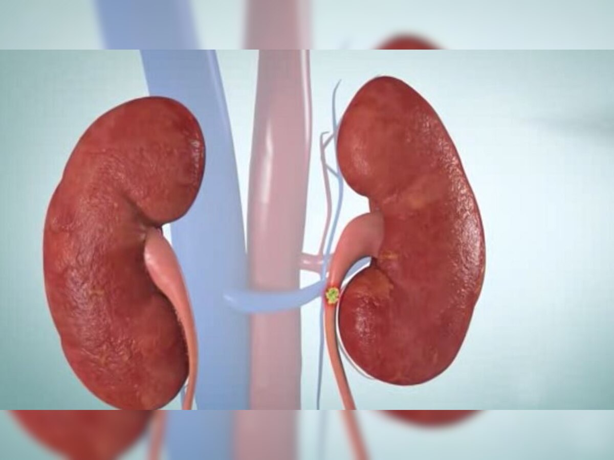 Kidney Health issue: अपनी जिंदगी में बदल दें ये आदतें, फेल हो गई किडनी तो पड़ सकता है पछताना