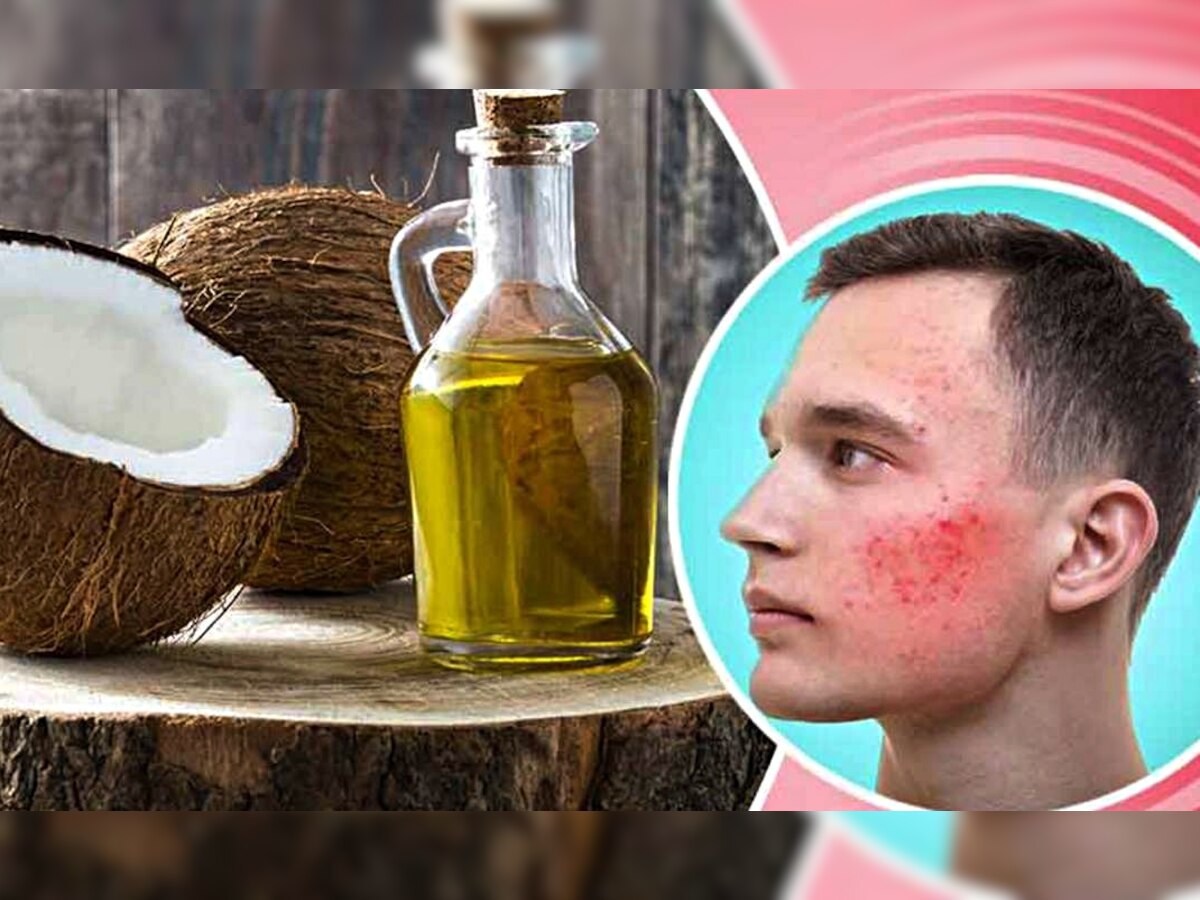 Coconut oil Home remedys: नारियल तेल में मिलाकर लगाएं ये एक रस, चेहरे की सभी समस्याओं का होगा रामबाण इलाज