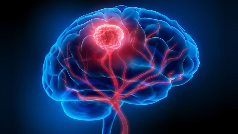 Brain Tumor Symptoms: शरीर में दिखने वाले इन 10 लक्षणों को कभी न करें इग्नोर, देते हैं ब्रेन ट्यूमर का संकेत; लापरवाही से जा सकती है जान