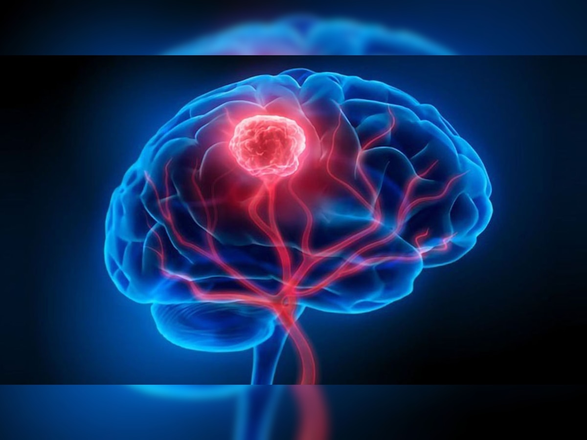 Brain Tumor Symptoms: शरीर में दिखने वाले इन 10 लक्षणों को कभी न करें इग्नोर, देते हैं ब्रेन ट्यूमर का संकेत; लापरवाही से जा सकती है जान