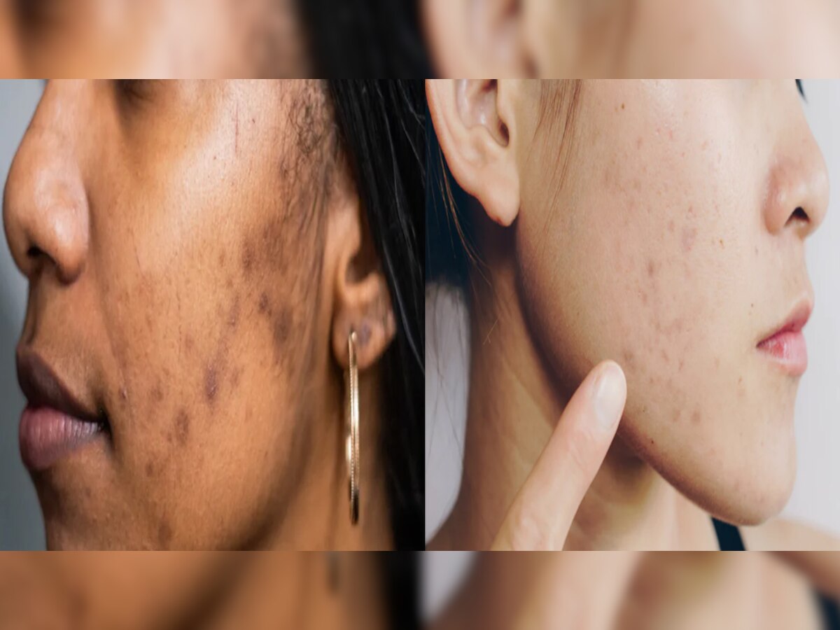 Acne Scars: चेहरे पर मुहांसों से पड़े धब्बों को कैसे हटाएं? ये हैं सबसे तेज और आसान तरीके