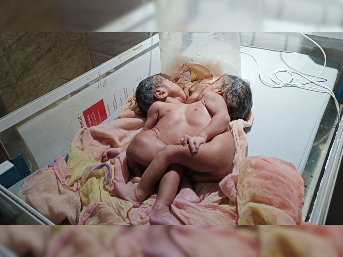 मेड़ता में छाती जुड़े अनोखे जुड़वां बच्चों का जन्म, देखने के लिए अस्पताल में उमड़ी भीड़
