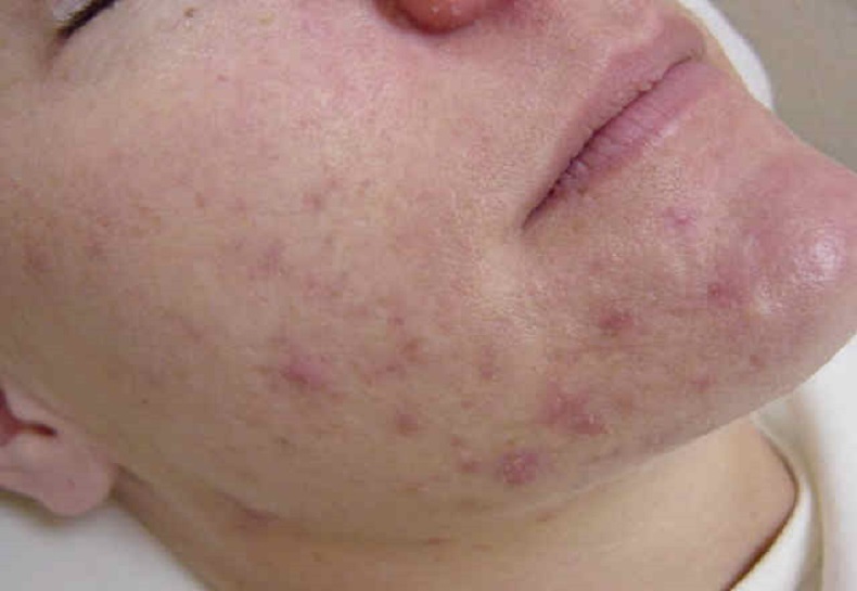 Cholesteriol Rash highcholesterol symptoms skin allergy acne to itchy face know warning ...