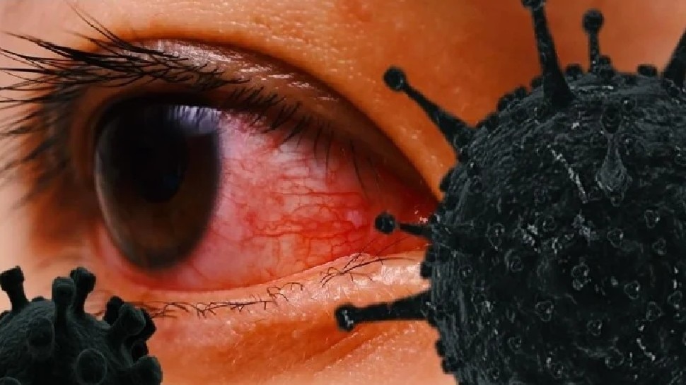 why eyes are removed in black fungus disease know symptoms nsmp Black