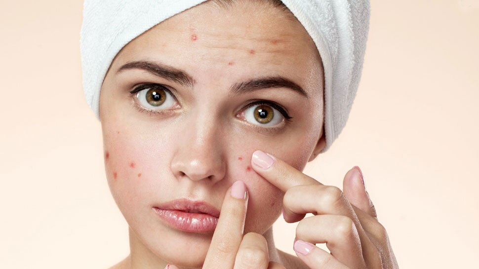 Pimples होने पर आप भी तो नहीं कर रहे ऐसी Mistakes, चेहरे को हो सकते हैं बड़े नुकसान