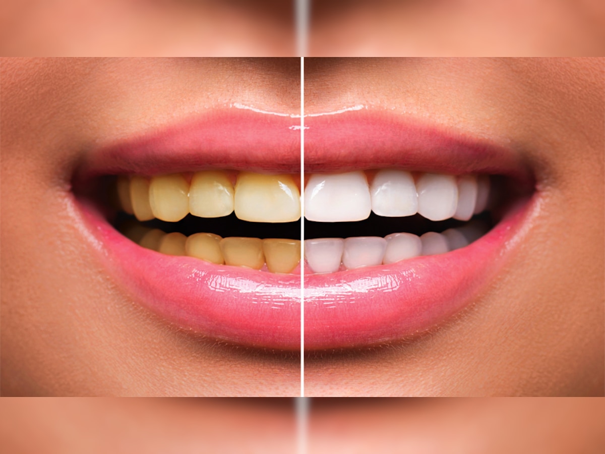 Teeth Whitening Powder: किचन में मौजूद इन चीजों का करें इस्तेमाल, मोती की तरह चमकने लगेंगे पीले दांत