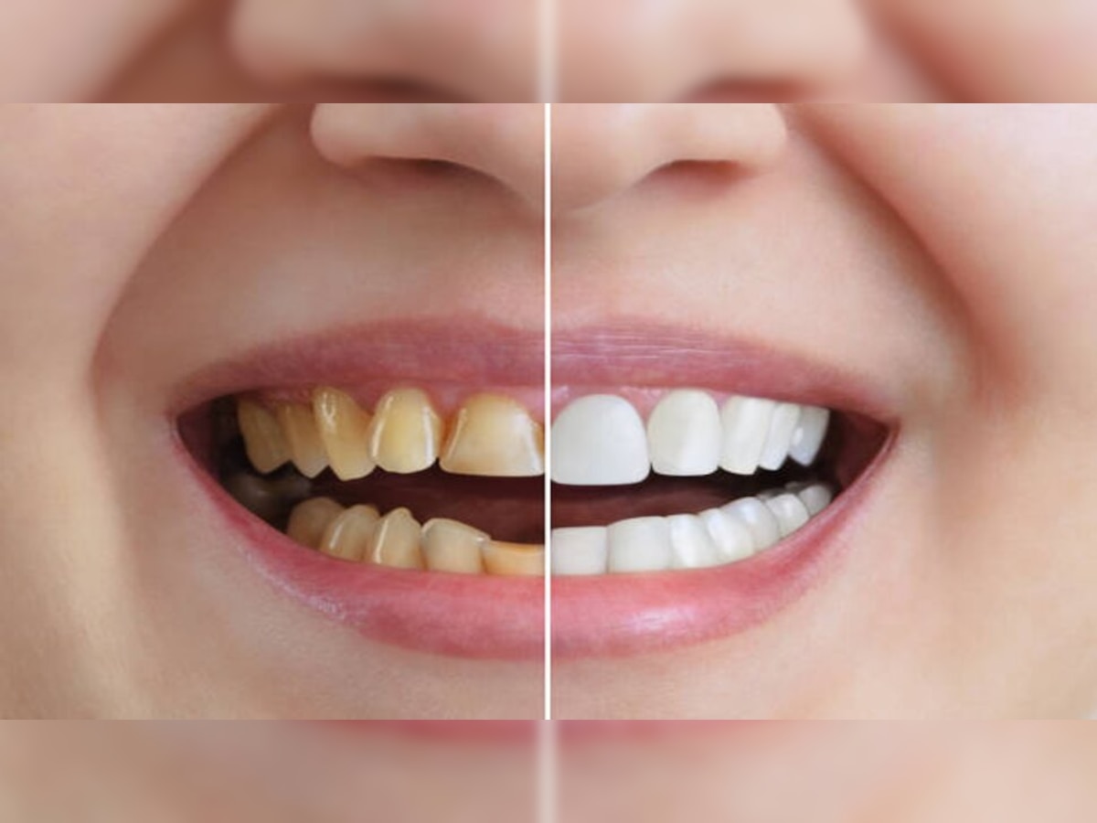 Teeth whitening at home: पीले दांत से हो गए हैं परेशान, सफेद और चमकते दांतों के लिए अपनाएं ये टिप्स 
