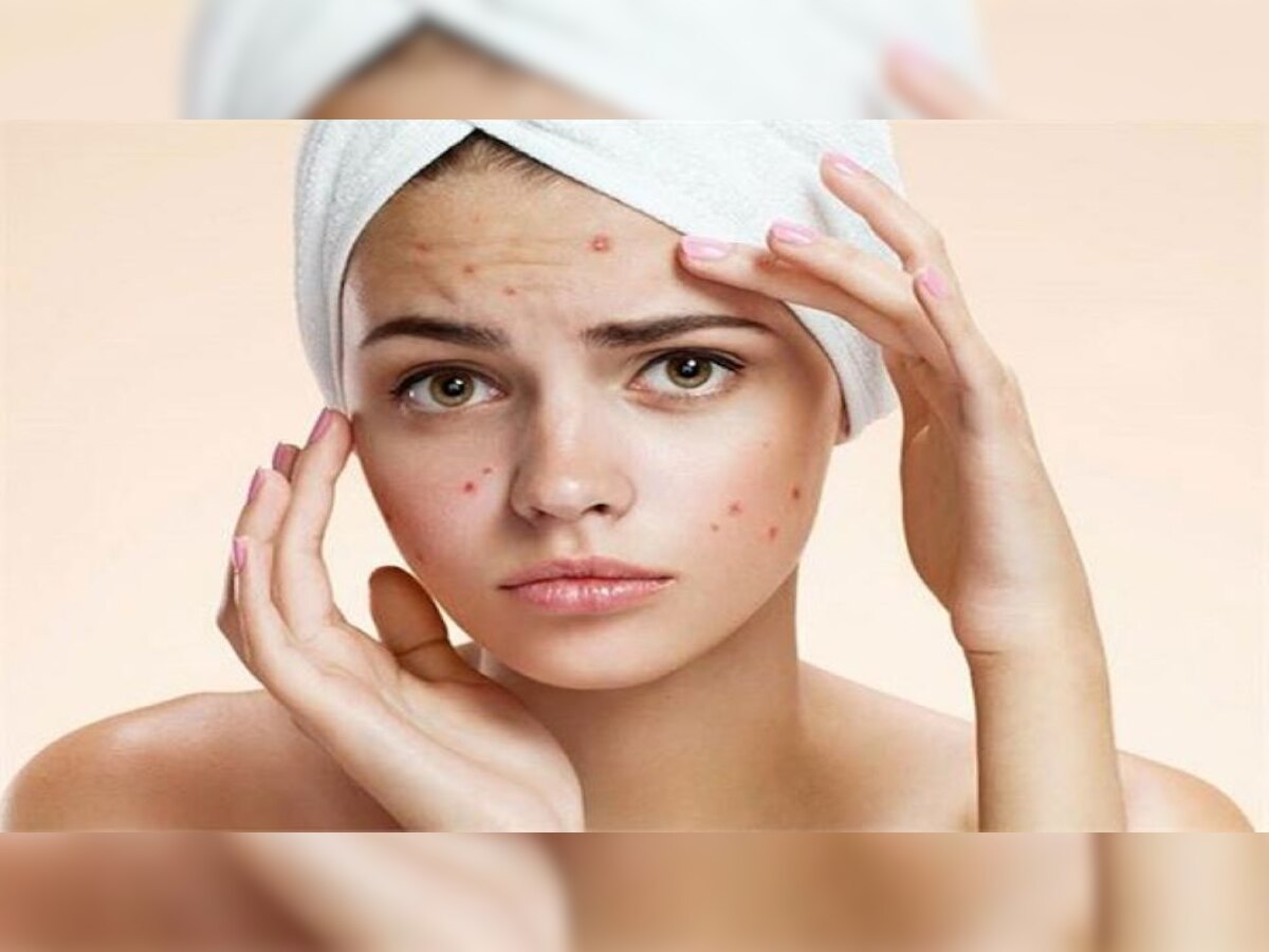 Skin Care Tips: चेहरे पर मुंहासे होने का कारण बन सकती हैं ये चीजें, आज ही इन से बनाएं दूरी