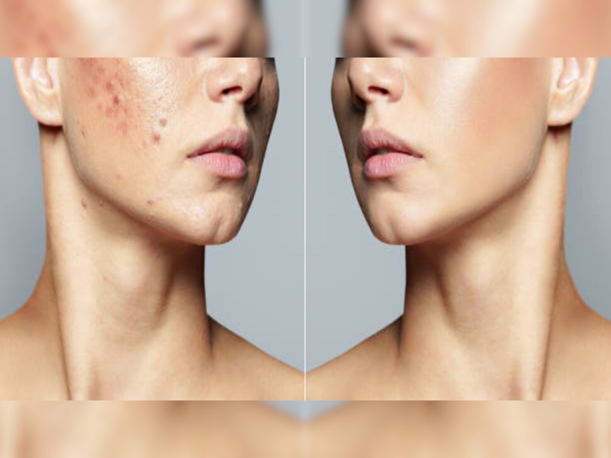 Pimples on face:  क्‍या आप चेहरे के दाग और मुंहासे से हैं परेशान, इन चीजों से खत्‍म होगी प्रॉब्‍लम  