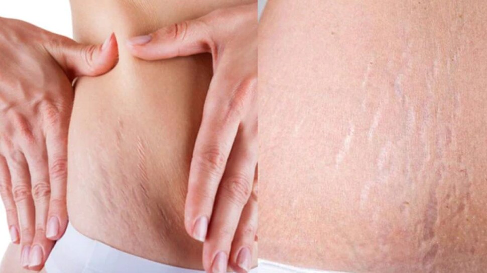 Remove stretch marks and how to control it SMI Remove Stretch Marks