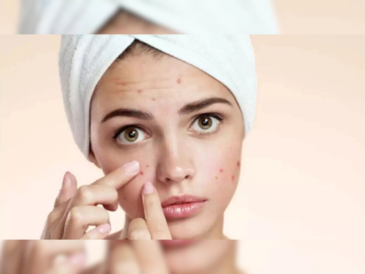 Home Remedies for pimples: क्‍या आपको भी हैं कील मुंहासे, इन घरेलू उपायों से हो जाएंगे जड़ से खत्म  