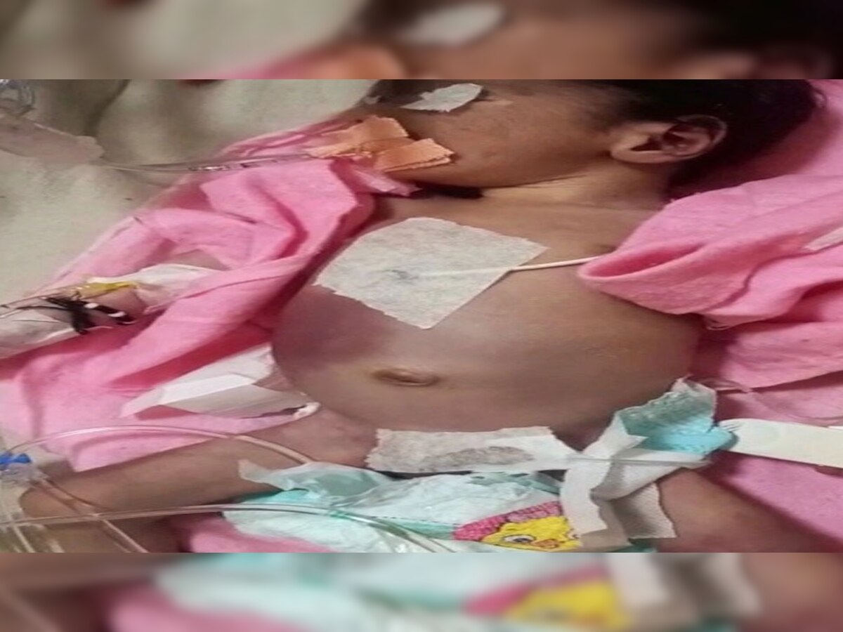 नर्सिंग स्टाफ की लापरवाही से एनआईसीयू वार्ड के वॉर्मर पर झुलसने से बच्ची की हुई मौत