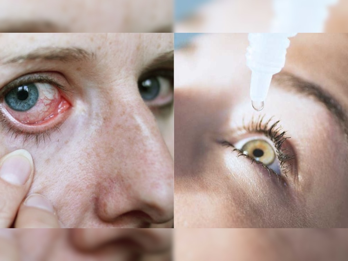 Dry eyes problem : सर्दियों में हो सकती है Dry Eyes की समस्या, बचने के लिए करें ये आसान उपाय 