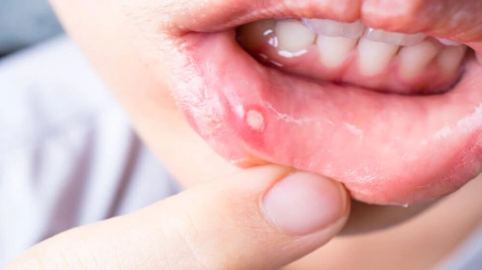 mouth-ulcer-home-remedies-in-hindi-muh-ke-chhale-ke-liye-medicine