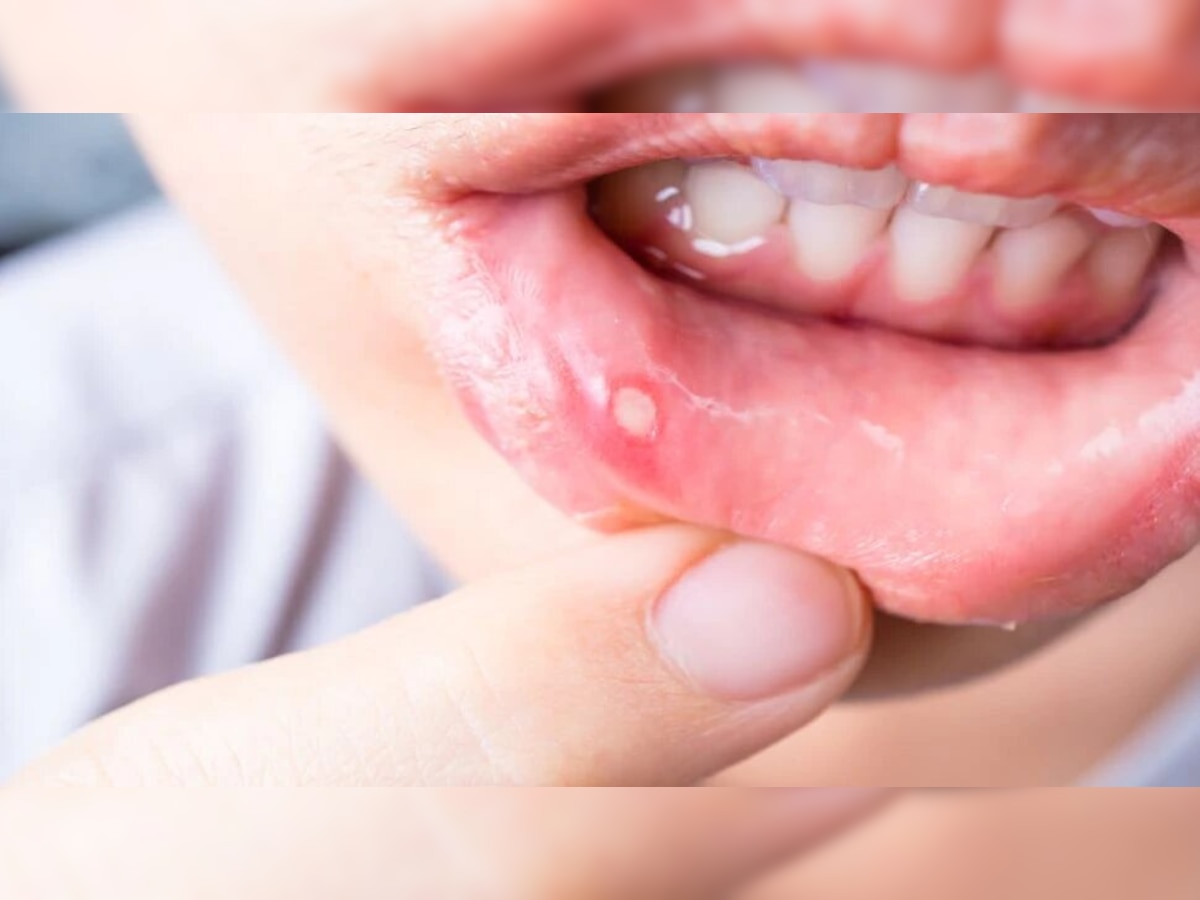 Mouth Ulcer: इन्फेक्शन हो या पेट की गर्मी,इन नुस्‍खों से चुटकियों में खत्‍म होंगे मुंह के छाले