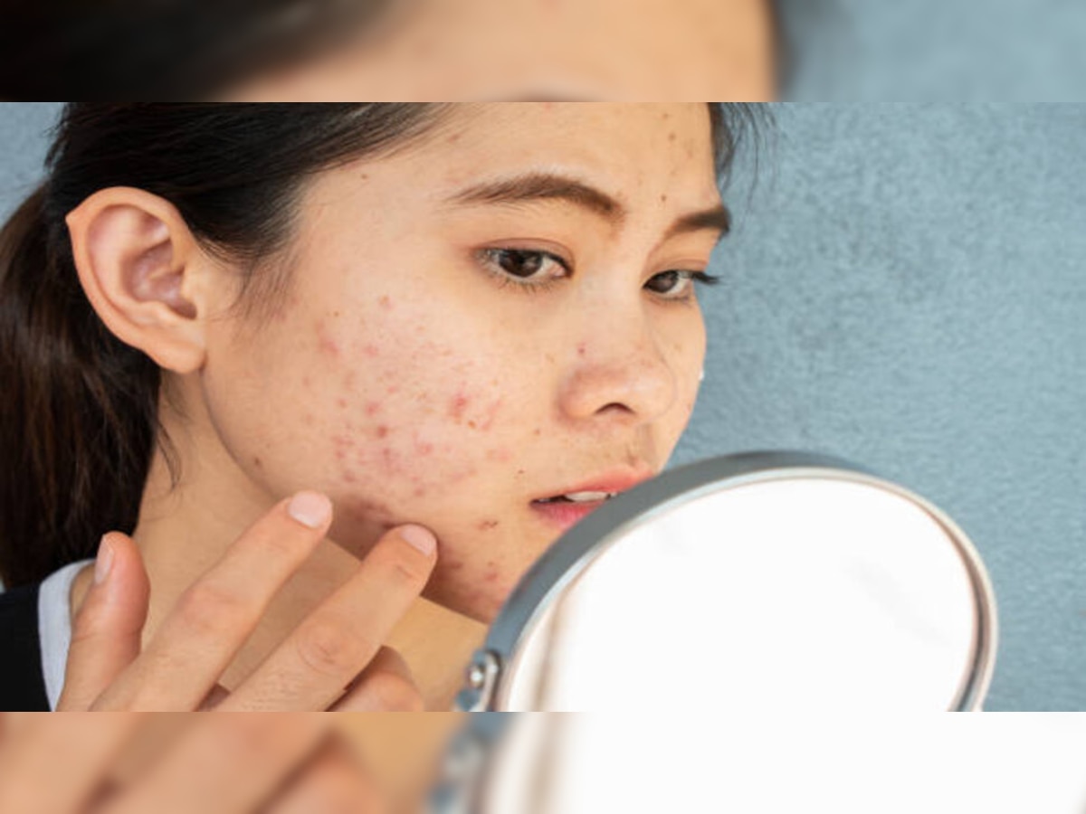 Skin Care Tips: गोली दवाई नहीं, इन घरेलू उपायों से भी खत्‍म हो जाते हैं चेहरे के मुंहासे