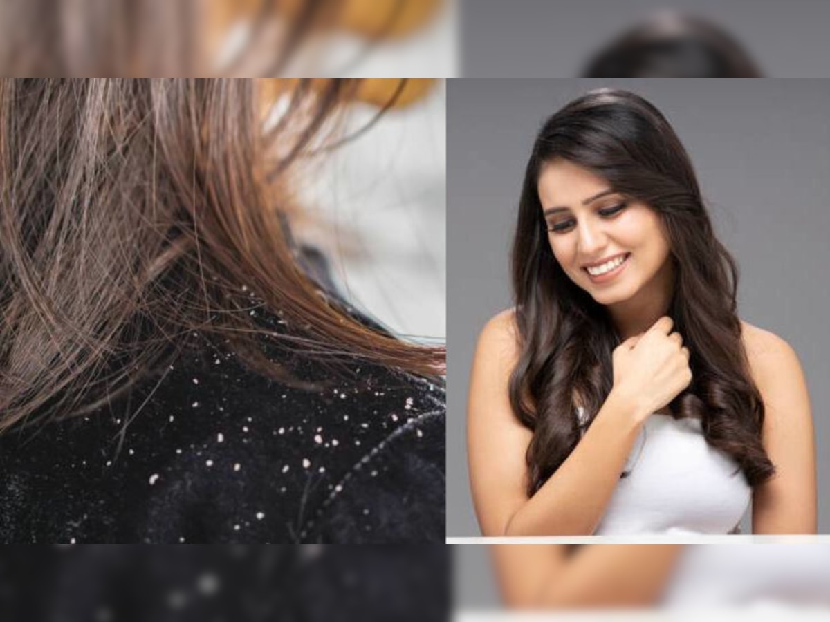 Dandruff Treatment: सिर्फ 10 रुपये में खत्‍म होंगे डैंड्रफ वाले बाल, अपनाएं ये घरेलू नुस्‍खे 