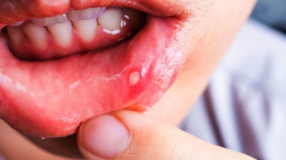 tips-for-mouth-ulcer-remedies-how-to-get-rid-of-mouth-ulcers-mouth