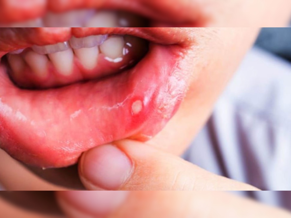 Mouth Ulcer Remedies: पेट की गर्मी से मुंह में पड़ जाते हैं छाले? जान लें काम के ये 3 असरदार नुस्खे, खर्च आएगा केवल 5 रुपये 
