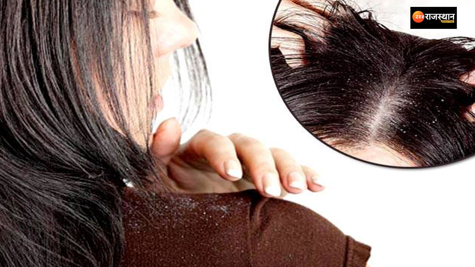 health news Why does dandruff make hair miserable in winter take care