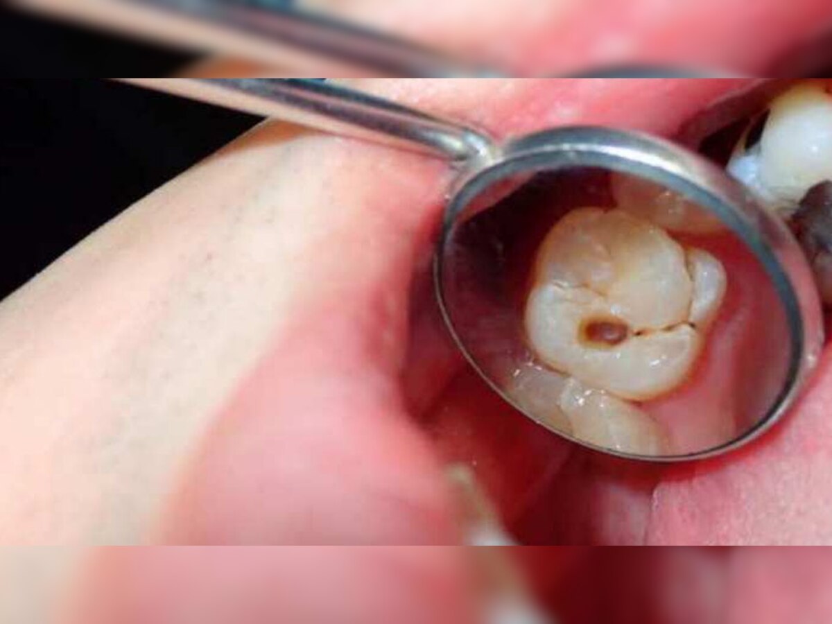 Tooth Cavity Remedies: दांतों की सड़न से हैं परेशान? इस्तेमाल करके देखें ये 4 घरेलू चीजें, कभी पास नहीं फटकेगी कैविटी 