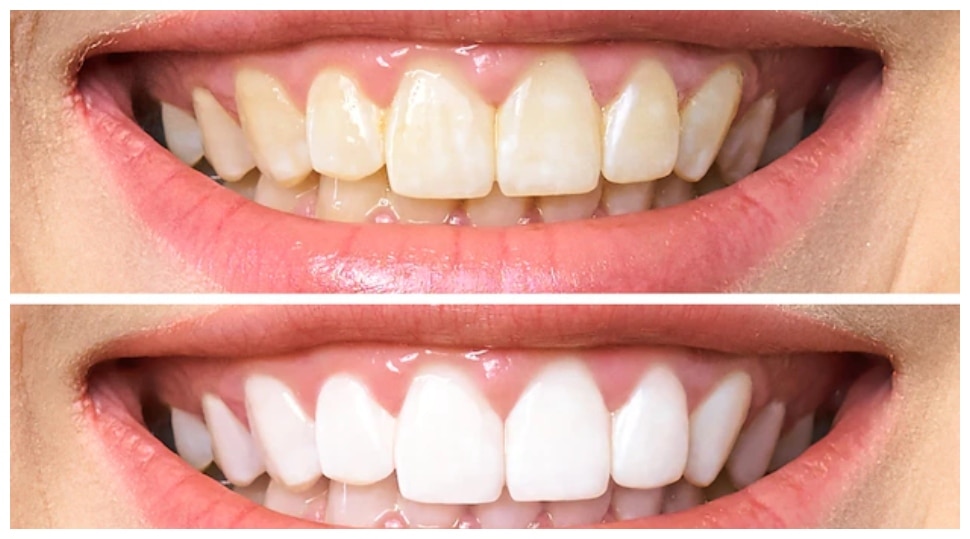 yellow-teeth-home-remedies-how-to-get-rid-of-yellow-teeth-problem