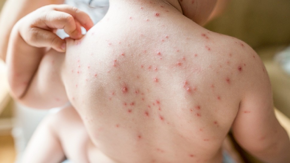 symptoms-of-measles-chickenpox-and-smallpox-are-difficult-to-recognize