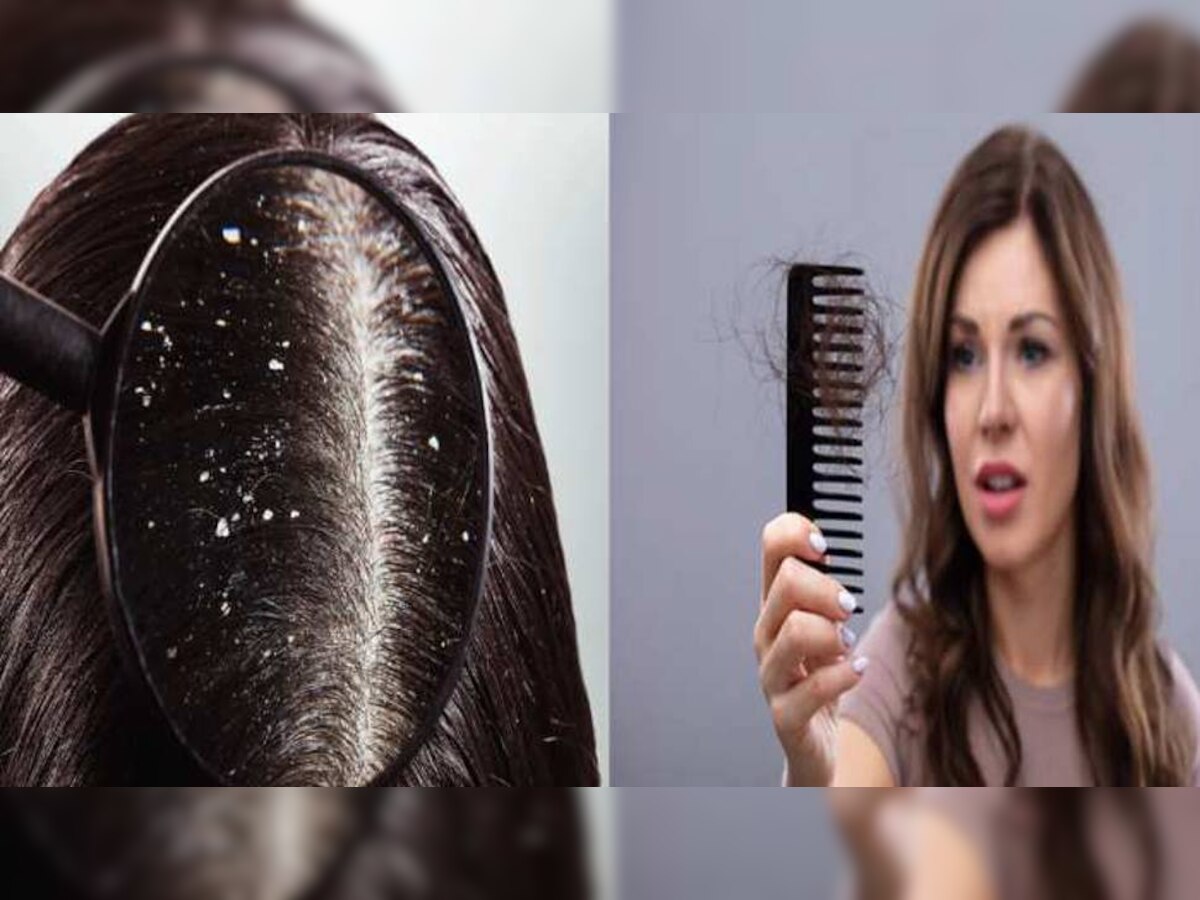 home remedies for Dandruff