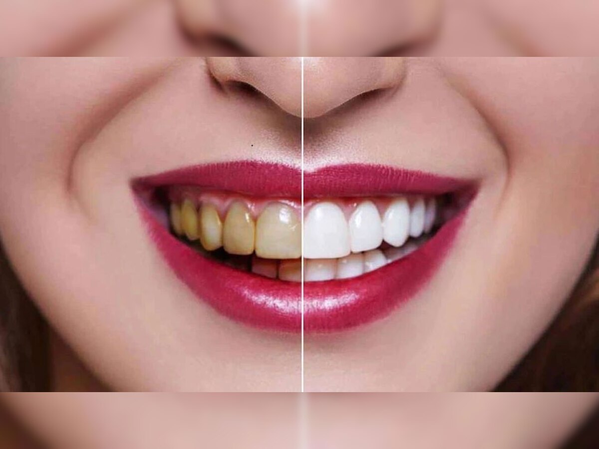 Clean Teeth: ଏହି ଘରୋଇ ଉପଚାରରେ ଚମକିବ ଆପଣଙ୍କ ଦାନ୍ତ, ପାଟିରୁ ଆସିବନି ଦୁର୍ଗନ୍ଧ 
