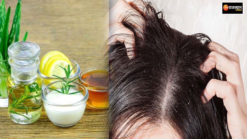 Dandruff Home remedies apply these easy tips to remove dandruff in winter Dandruff Home