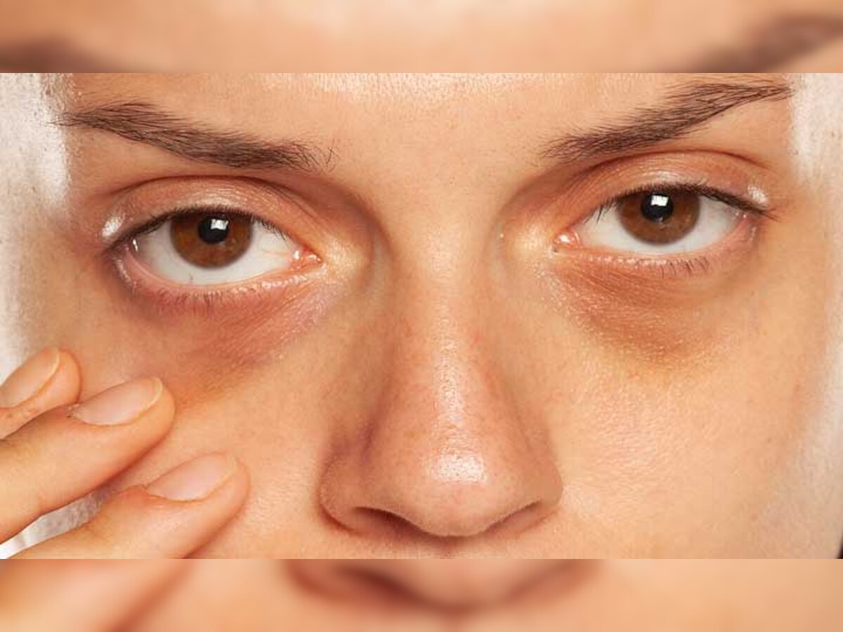 Dark Circles: आंखों के नीचे हो गए हैं डार्क सर्कल? इन तरीकों से पाएं छुटकारा