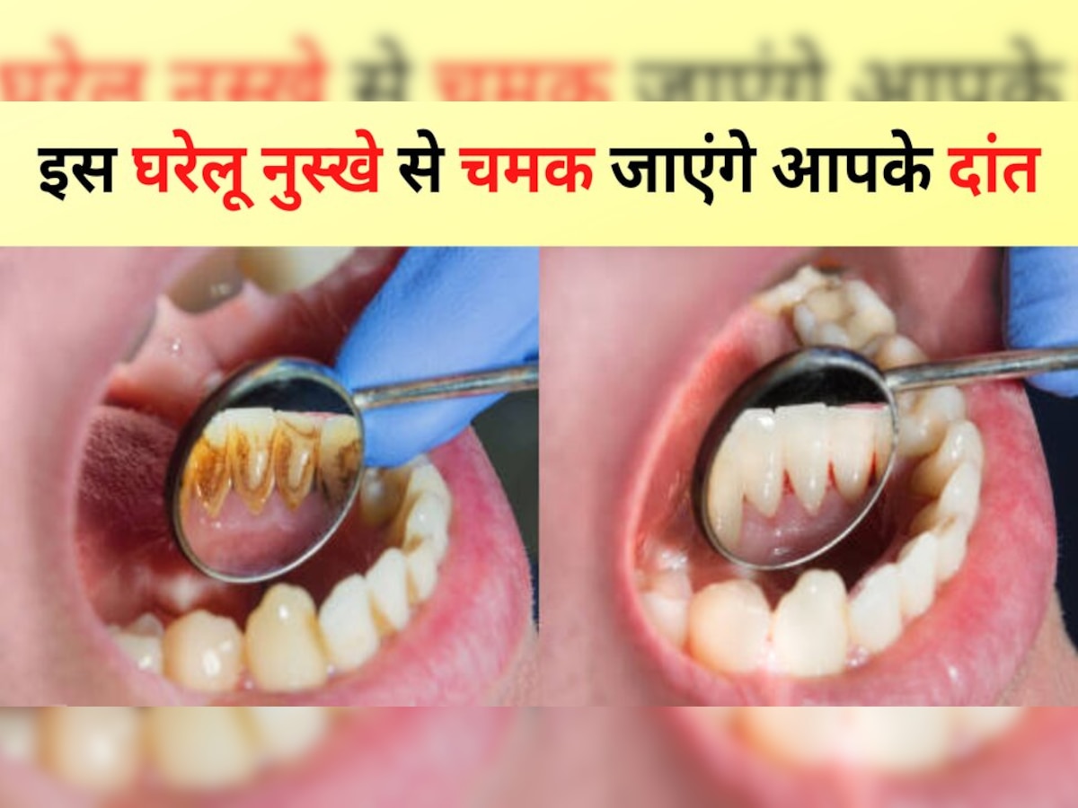 Teeth whitening at home: दांतों का पीलापन झट से होगा गायब, चमकेंगे दांत नहीं झेलनी पड़ेगी शर्मिंदगी 